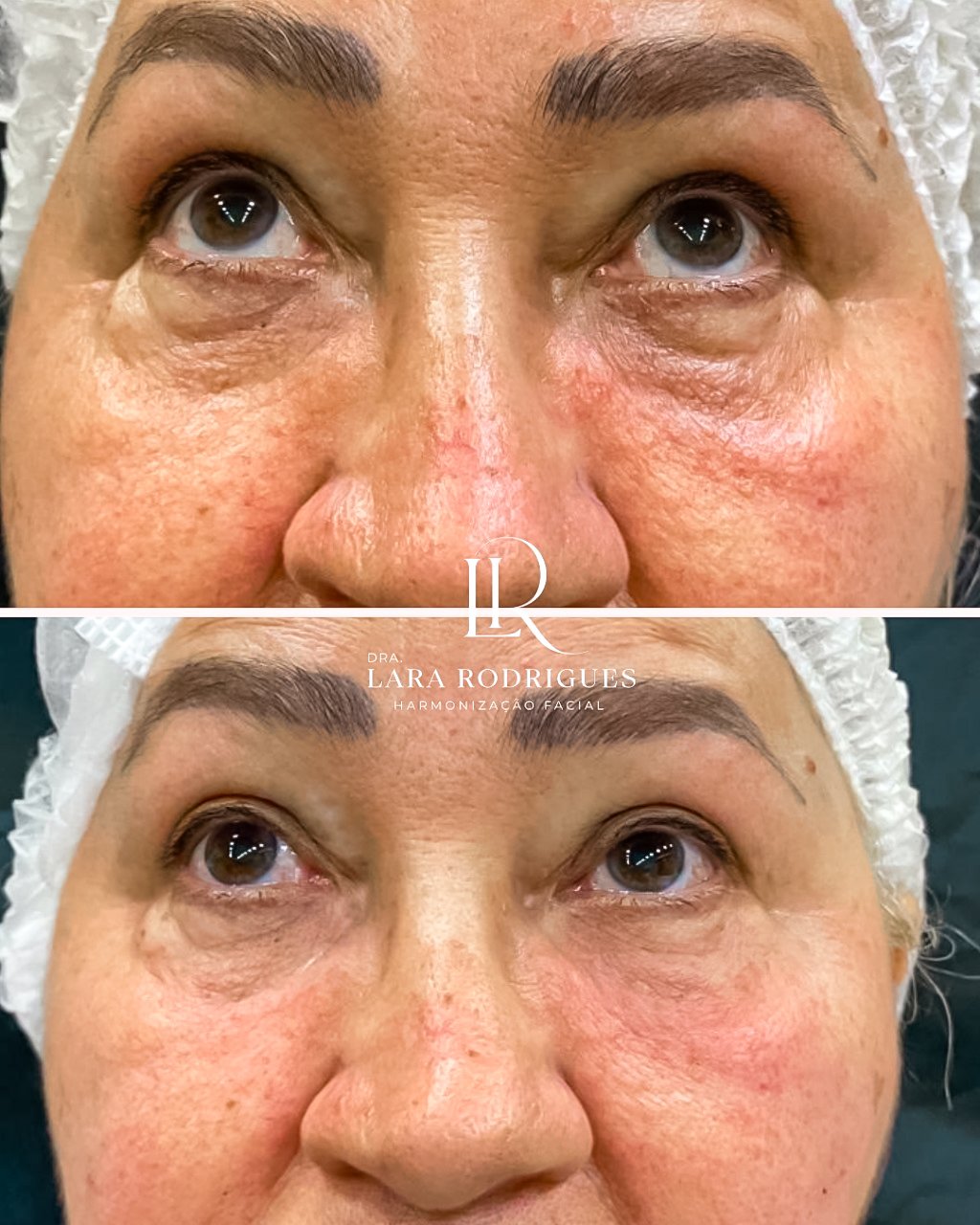 Preenchimento olheiras