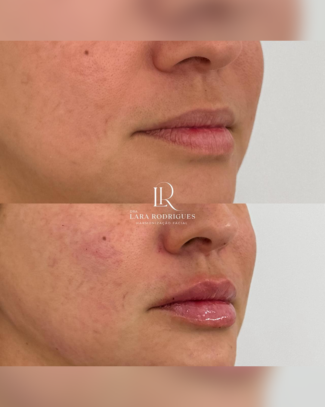 Preenchimento labial